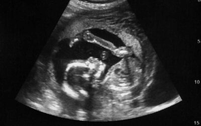WHAT TO EXPECT FROM AN EARLY ULTRASOUND SCAN